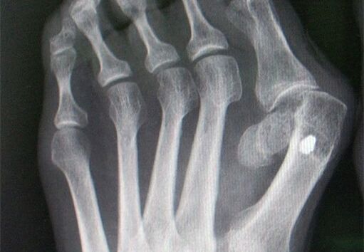 X -RAY