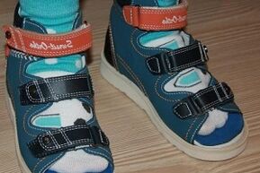 usando sandálias para hálux valgo em uma criança