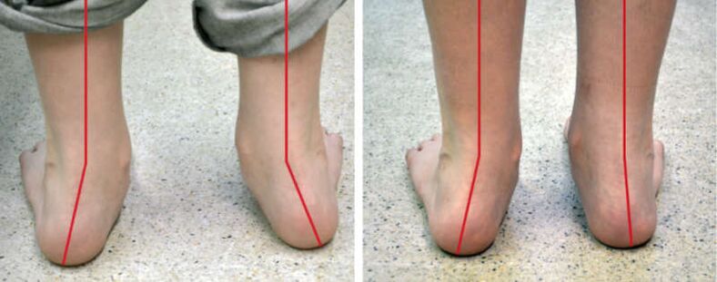 Valgus pernas