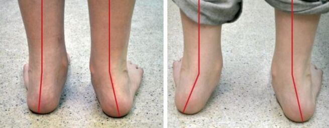 Pé Valgus