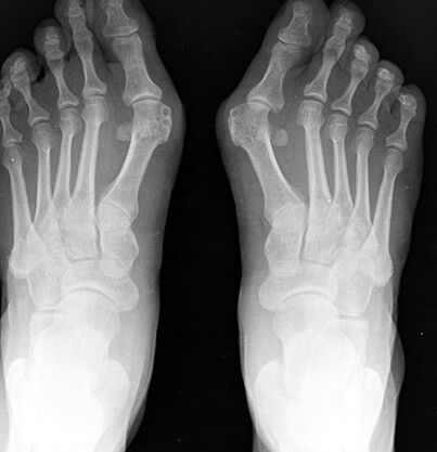 X -Ray do pé
