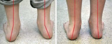 Curvatura de Valgus